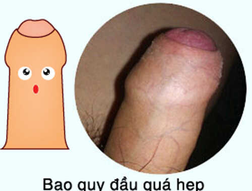 Bao quy đầu quá hẹp
